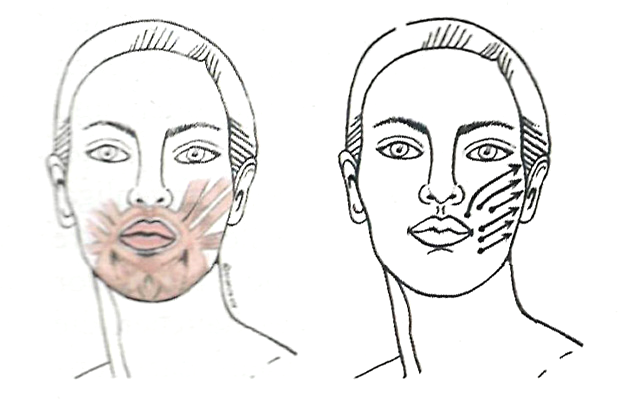 Подтяжка нижней части лица, щек и разглаживание носогубок (Б. Кантиени)
